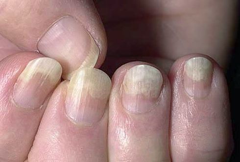 Peeling de la plaque de l'ongle des tissus mous