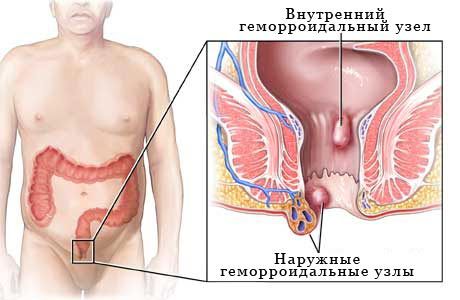 Prévalence des hémorroïdes