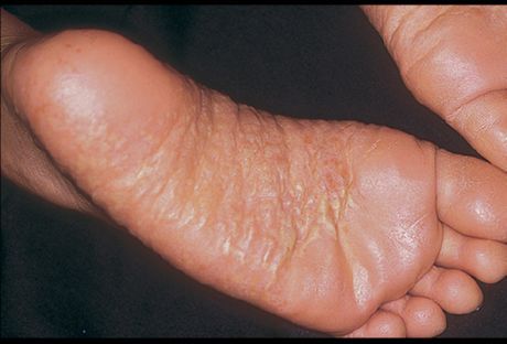 Dermatite des jambes et ses causes