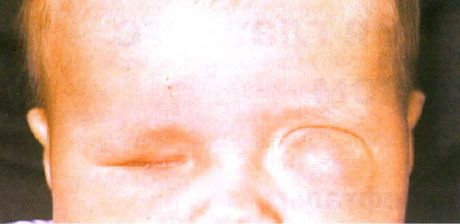 Microphtalmie avec formation concomitante de kystes (œil gauche).  Anophtalmie (oeil droit).