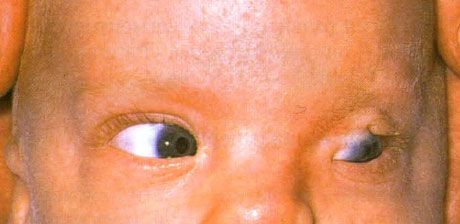 Syndrome de Fraser.  Cryptophtalmie incomplète de l'œil gauche.