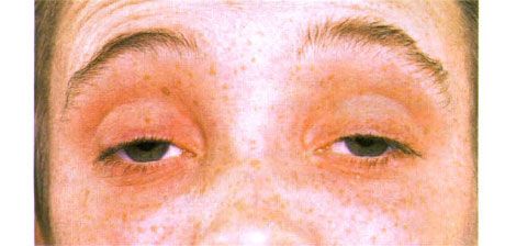 Ophtalmoplégie externe.  Ptosis bilatéral.  Le patient ouvre les yeux en haussant les sourcils