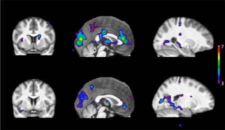 Le balayage montre des zones d'activité cérébrale en réponse à des stimuli chez les personnes ayant un métabolisme rapide de la nicotine (rangée supérieure) et un métabolisme lent de la nicotine (rangée inférieure)