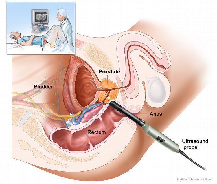 Un médicament efficace contre le cancer de la prostate à base de thé et d'or a été créé