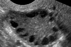 Syndrome Des Ovaires Polykystiques : Causes, Symptômes, Diagnostic ...