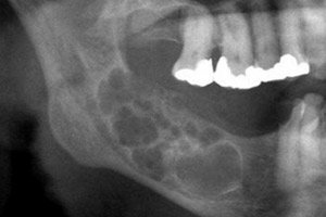 Ameloblastome Symptomes Types Diagnostic Traitement