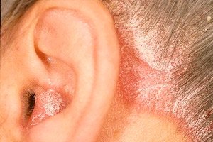 Eczema Des Oreilles Chez L Adulte Et L Enfant Symptomes Traitement