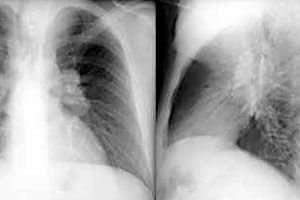 Ganglions Lymphatiques Enfles Dans Les Poumons Causes Et Traitement
