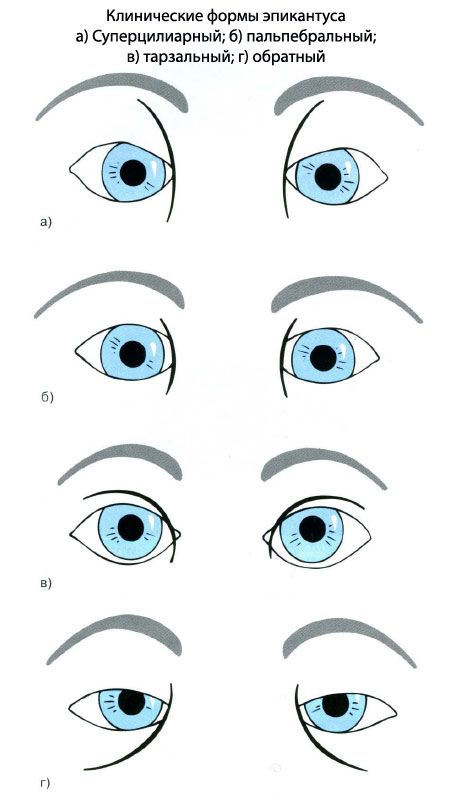 Formes cliniques de l'épicanthus.  a) sourcilière, b) palpébrale, c) tarse, d) inverse